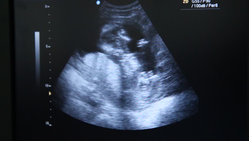 Ultrasonography Analysis of a 4th Month Fetus