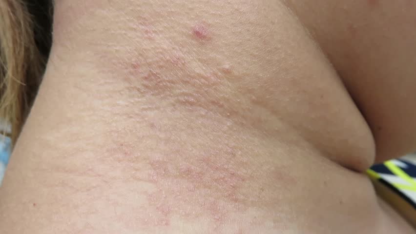 Header of allergy