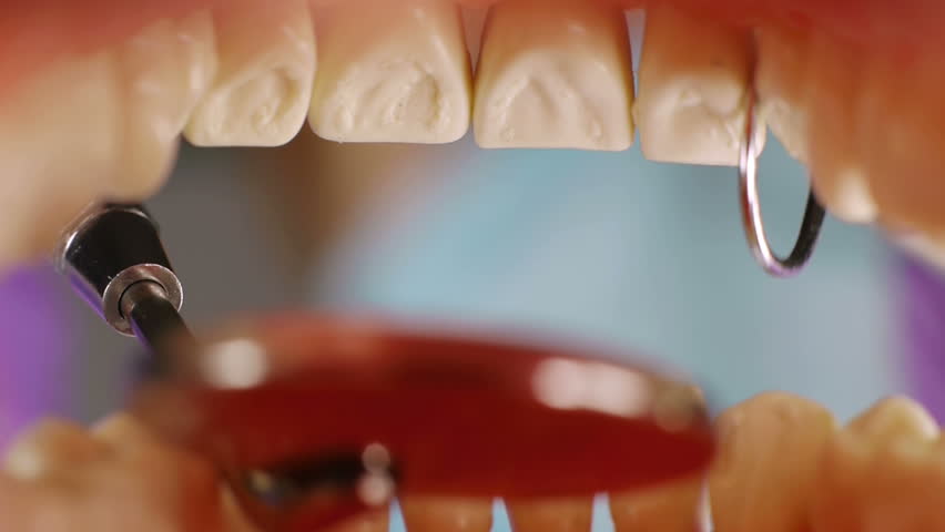 Teeth Inside Mouth Cleanup (HD). Dentist cleaning teeth Inside mouth with hook remover tool and mirror. Shot with custom made mouth prosthesis.
