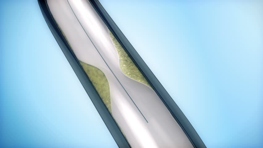 Coronary Angioplasty procedure - plague blocking blood flow