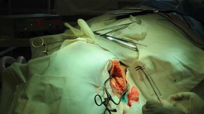 Operation. Surgical table. implantation
