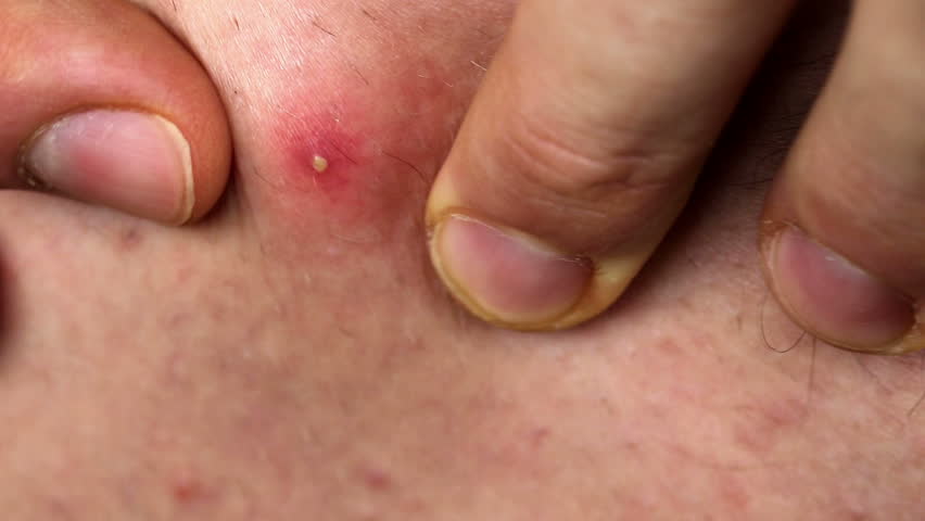 Pimple Popping