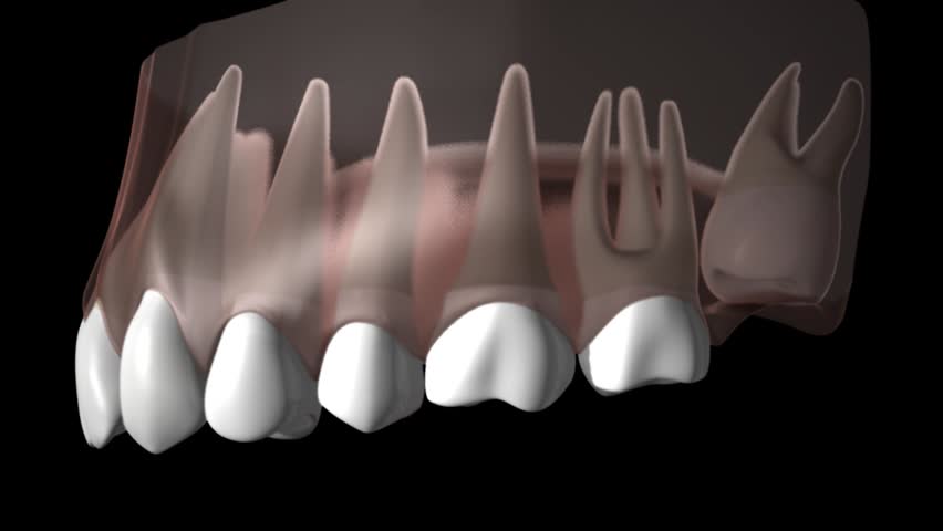 Side view of 3D perspex zoom upper gums and teeth showing growth of wisdom tooth displacing other teeth then being removed 