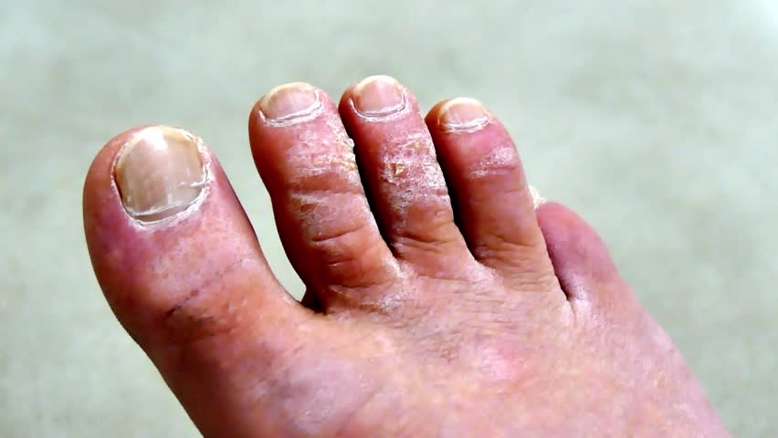 toe-fungus-diseases-human-foot-stock-footage-video-100-royalty-free