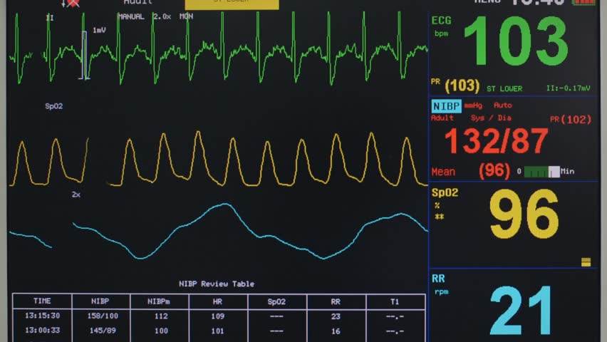 Ekg Monitor in Icu Unit Stock Footage Video (100% Royalty-free