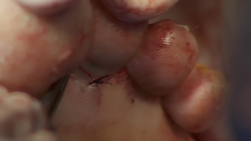 Header of nodular