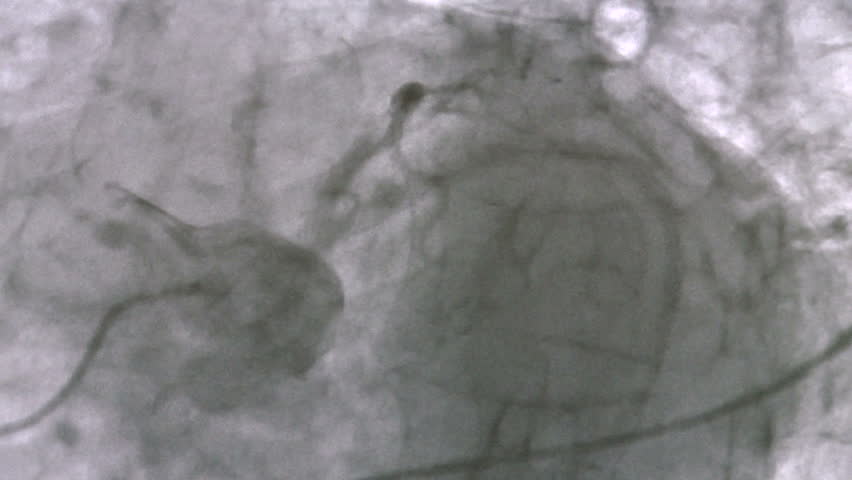 Header of coronary