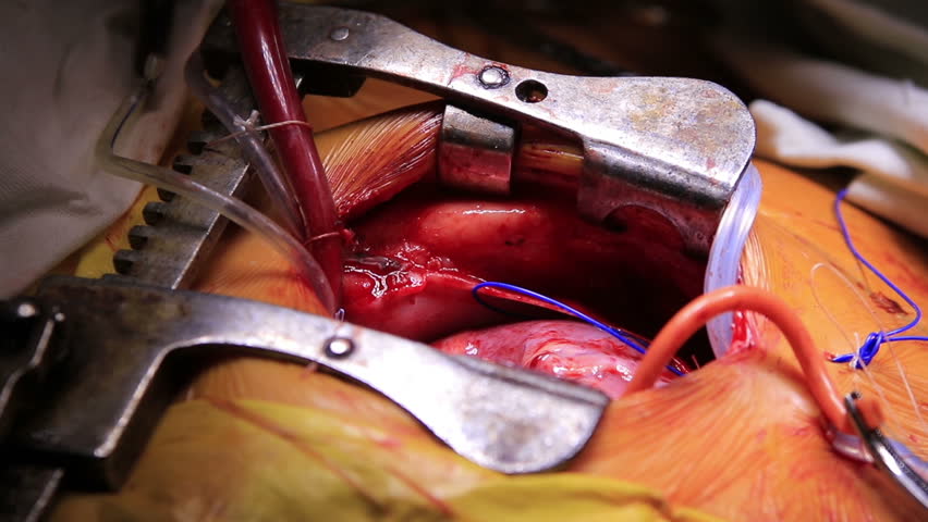 Open Heart Surgery Closeup With Connected Cardiopulmonary