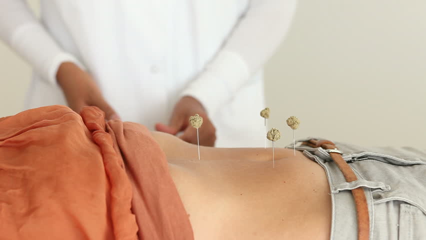 Alternative Medicine Female Doctor Applying Acupuncture Needles With