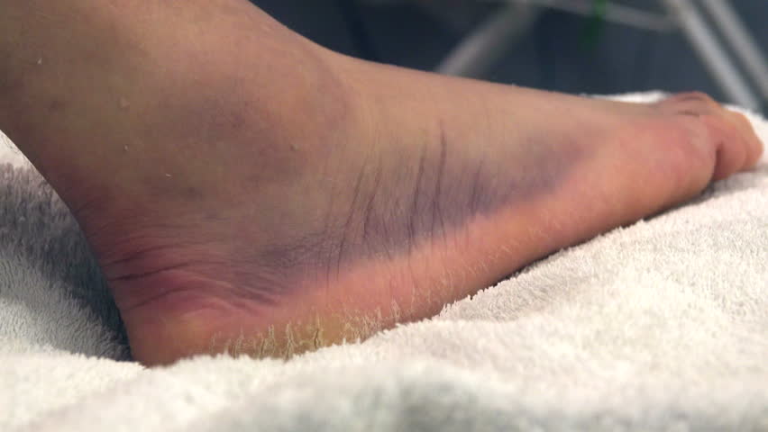 Header of ligament